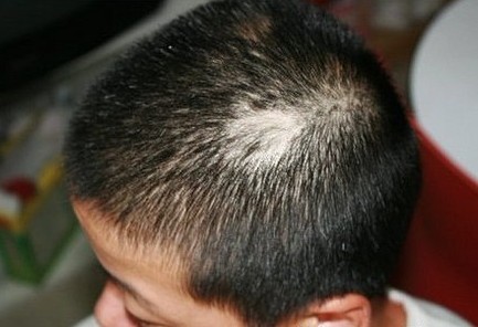 医师解析脱发的原因