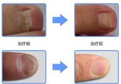 温州治疗灰指甲怎么样